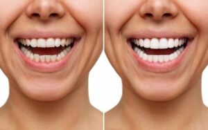 The Perfect Smile Solution: Unveiling the Power of Veneers - Hurd Family Dental