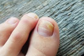 Fungal Nail Infections